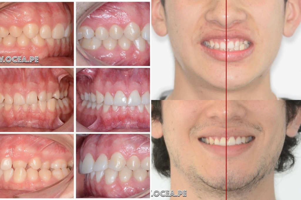 La mordida cruzada no es solo un problema de posición dental.