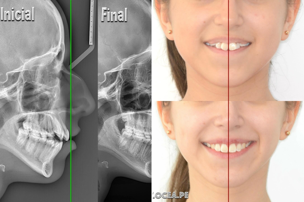 La estética de la sonrisa puede mejorar cuando el tratamiento ortodóntico se planifica a partir de un diagnóstico preciso.